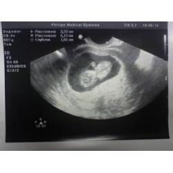 10 Weeks Pregnant: Symptoms, Fetus Ultrasound, Belly Photos