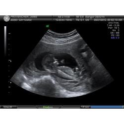 13 Weeks Pregnant: Symptoms, Fetus Ultrasound, Belly Photos