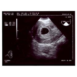 6 Weeks Pregnant: Symptoms, Fetus Ultrasound, Belly Photos