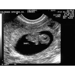 9 Weeks Pregnant: Symptoms, Fetus Ultrasound, Belly Photos